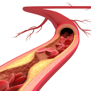 Blog-post-86-atherosclerosis